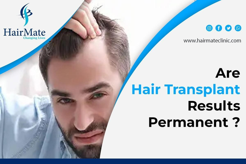 Are Hair Transplant Results Permanent?