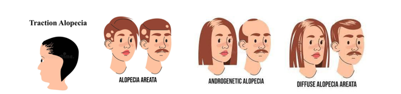 Types Of Hair Loss
